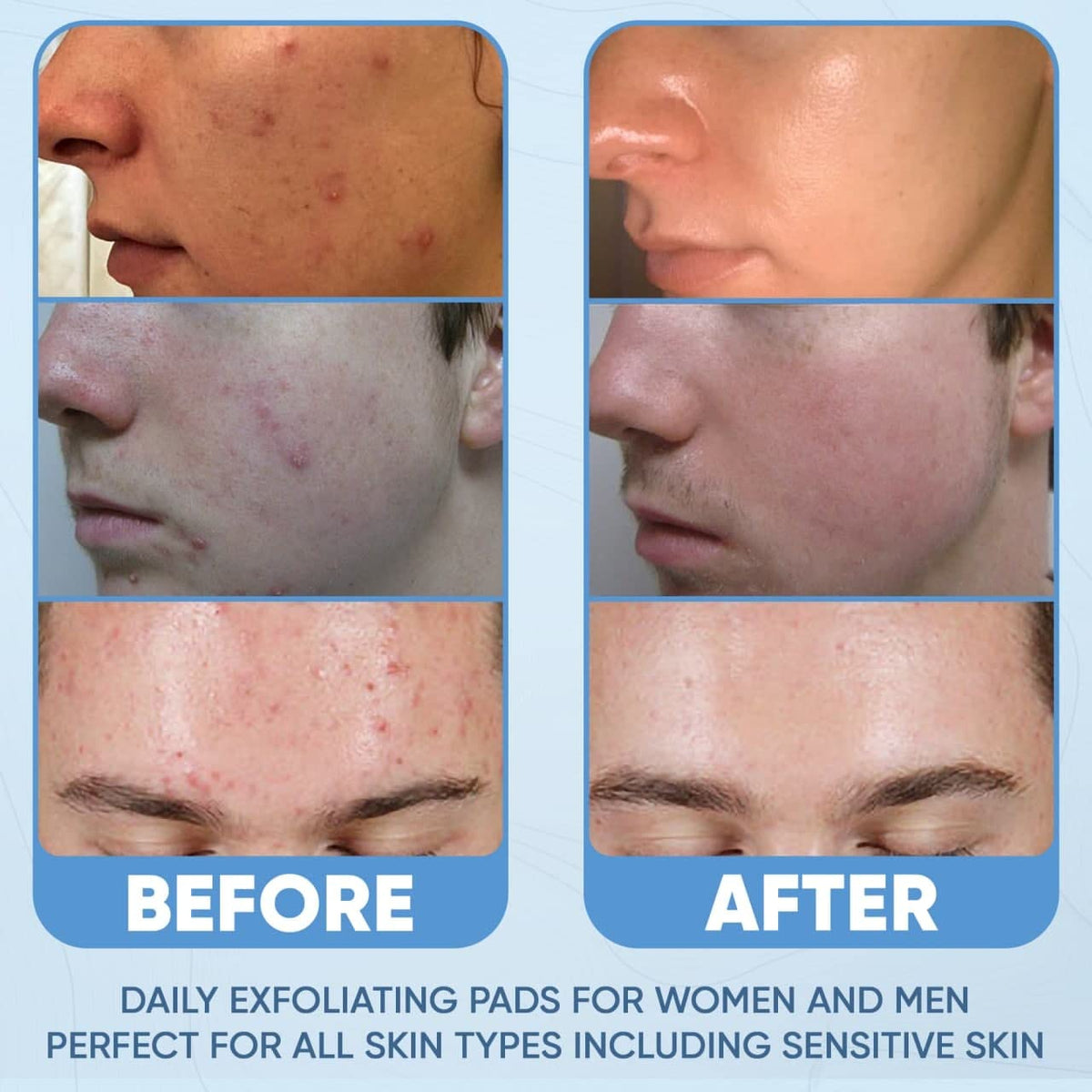 Salicylic Acid Acne Pads - Daily Skin Care Treatment freeshipping - ESTETIST LLC