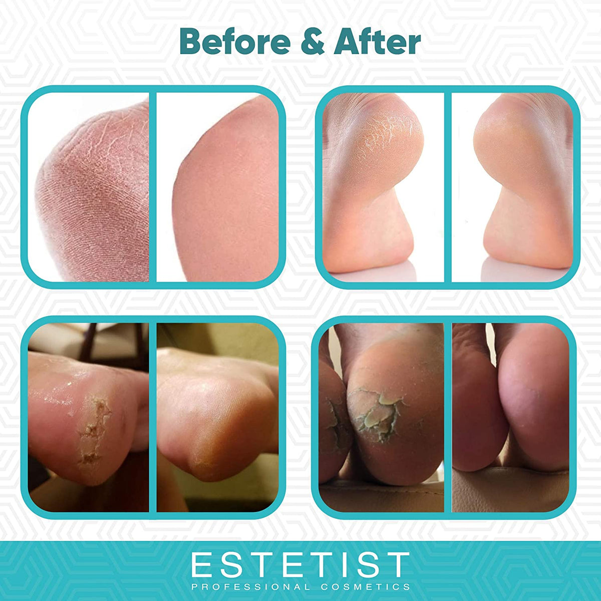 40% Urea Foot Cream - Moisturizer For Cracked Feet freeshipping - ESTETIST LLC