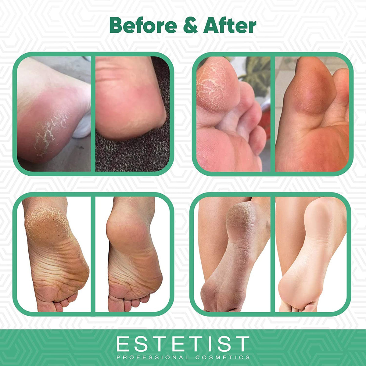 Tea Tree Foot Cream - Antifungal Foot Treatment freeshipping - ESTETIST LLC